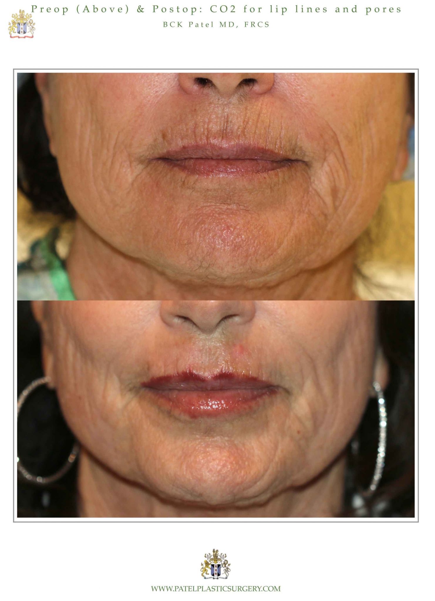 Nice results with improvement of lip andmouth smoker's lines with the use of the CO2 laser by Dr. BCK Patel MD, FRCS, Salt Lake City, London, St George