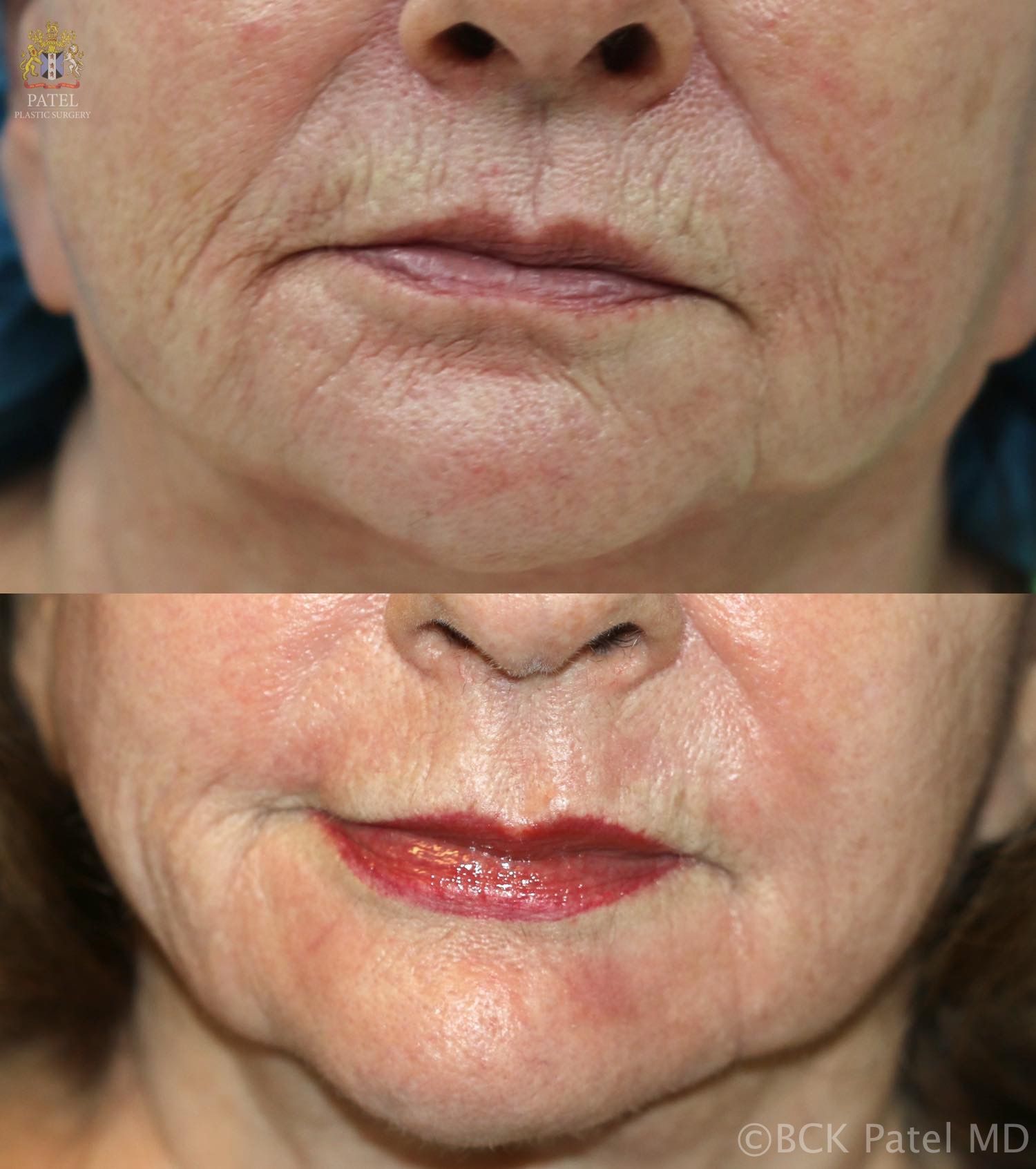 Nice results with improvement of lip andmouth smoker's lines with the use of the CO2 laser by Dr. BCK Patel MD, FRCS, Salt Lake City, London, St George