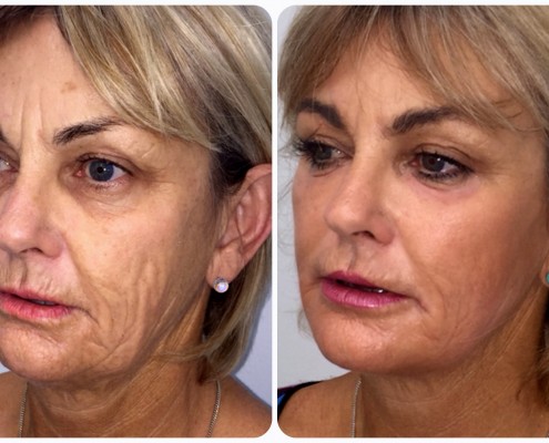 Minimally invasive lower facelift and necklift using threads