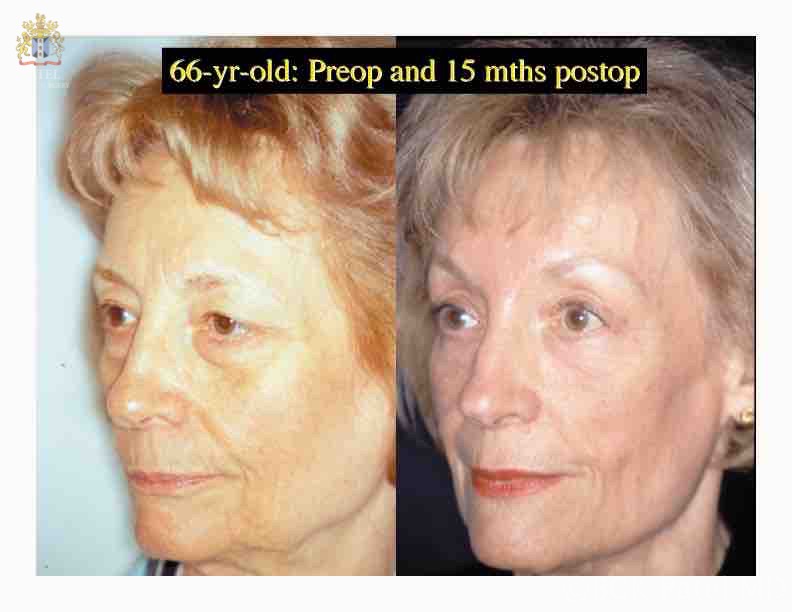 englishsurgeon.com. Photos show results of browlifts and cheeklifts