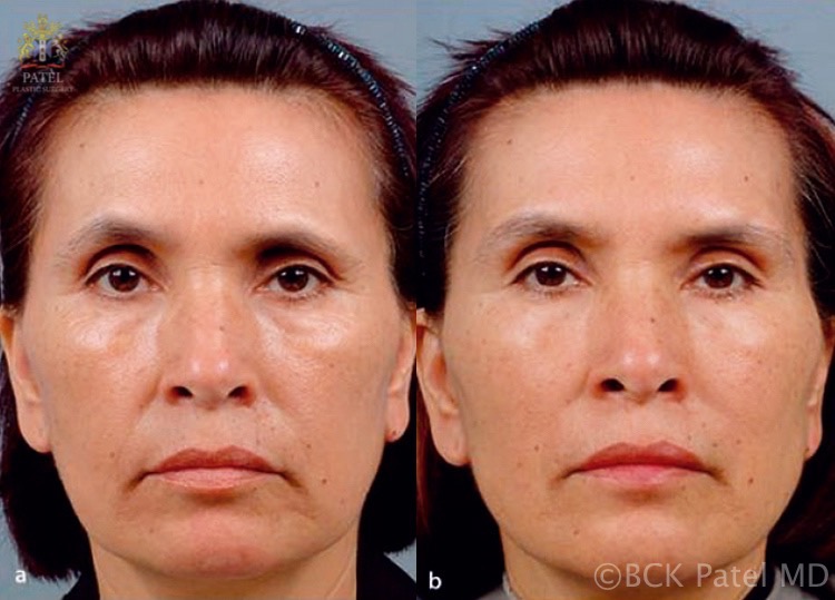 Results of Accent radiofrequency treatments to the face. BCK Patel Md