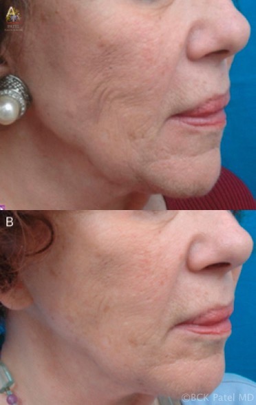 Results of Accent radiofrequency treatments to the face. BCK Patel Md