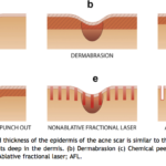 englishsurgeon.com. Diagrams showing the depths of acne scars and the response to different treatment modalities including lasers