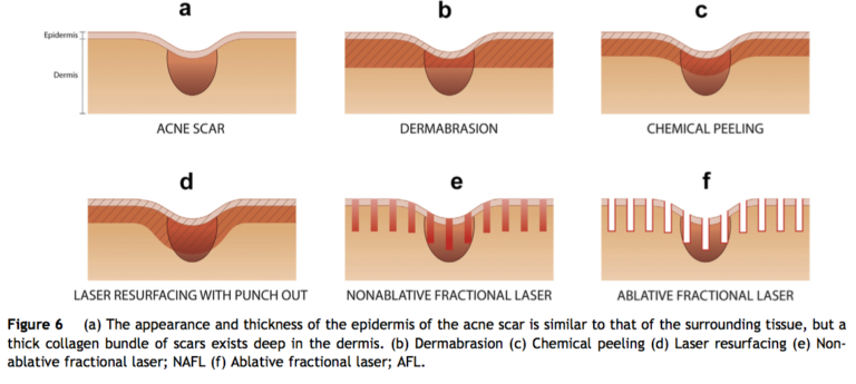 englishsurgeon.com. Diagrams showing the depths of acne scars and the response to different treatment modalities including lasers