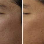 englishsurgeon.com. Photos showing the result of fotofacial laser treatment for CO2 scars