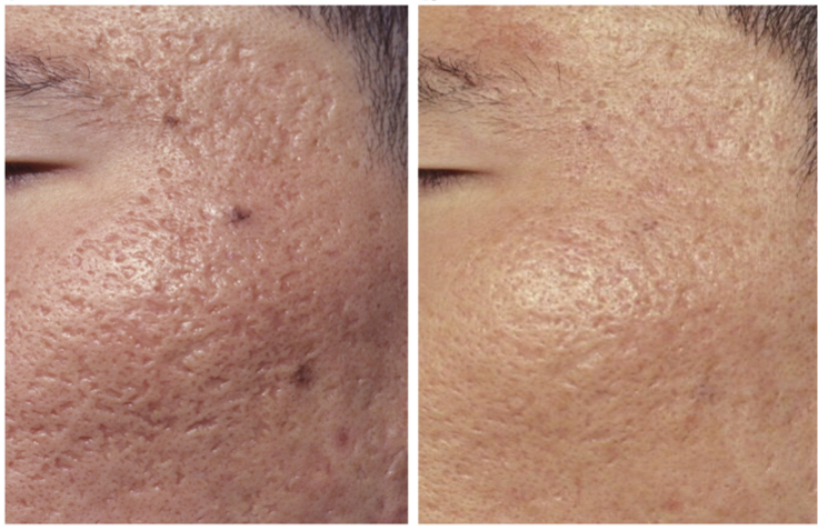 englishsurgeon.com. Photo showing the results of CO2 treatment of acne scars on the face