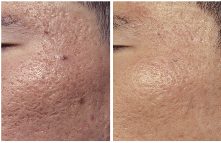 Advanced Acne Scar Treatments With Fractionated Lasers