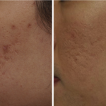 englishsurgeon.com. Photos showing results of Erbium treatment of the skin scars from acne