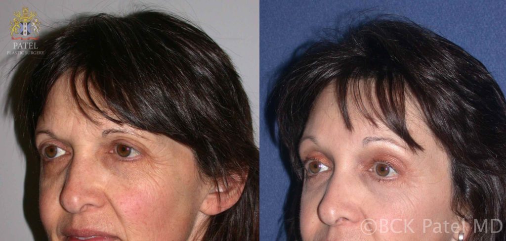 englishsurgeon.com. Photos show improvement in brow positions with endoscopic browlifts