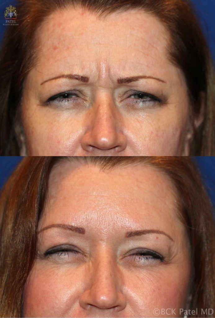 englishsurgeon.com. Photos showing the improvement of the frown lines