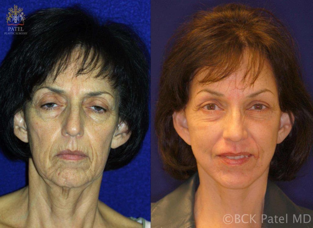 englishsurgeon.com. Photos show before-and-after results of browlifts and facelift