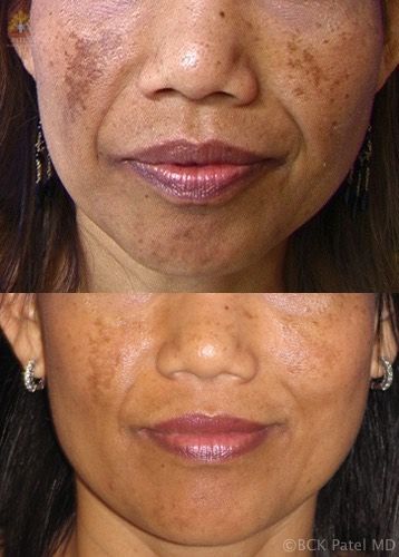 Results of face fotofacial treatments by Dr. BCK Patel MD, FRCS, Salt Lake City, St George