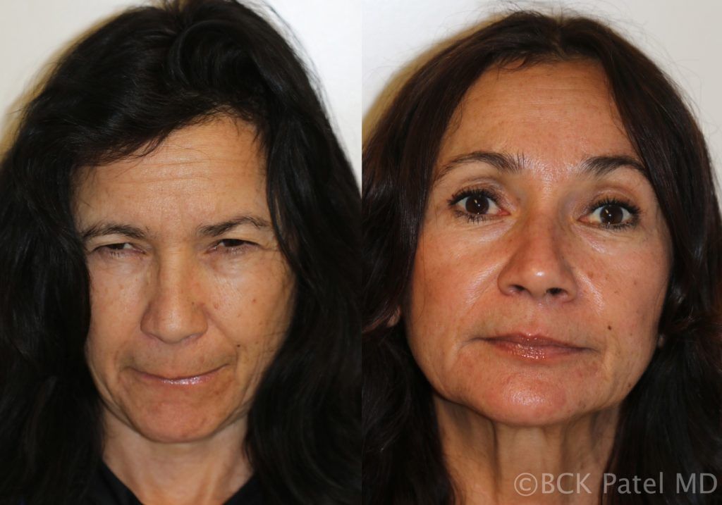 englishsurgeon.com. Photo showing results of browlifts and blepharoplasty by Dr. BCK Patel MD, FRCS of Salt Lake City, Utah and St. George