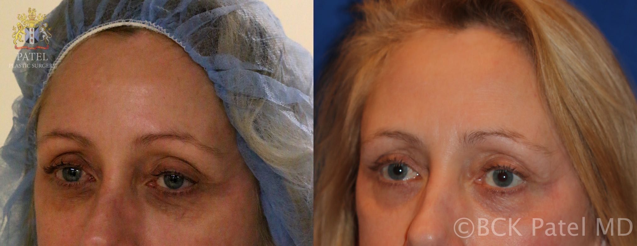 Before and after photos showing a nice improvement in the colour and texture of lower eyelid skin after fractionated CO2 laser. BCK Patel MD, FRCS, Salt Lake City