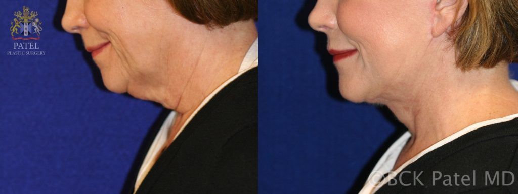 Photos show results of a facelift and necklift in a female with a tight jawline and neck. BCK Patel MD, FRCS