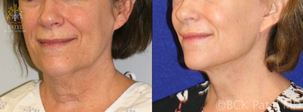 englishsurgeon.com. Photos show results of a facelift and necklift in a female with a tight jawline and neck. BCK Patel MD, FRCS