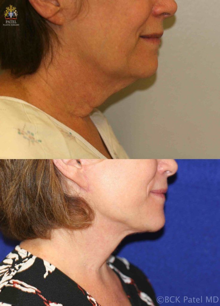 englishsurgeon.com. Photos show results of a facelift and necklift in a female with a tight jawline and neck. BCK Patel MD, FRCS