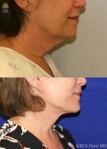 englishsurgeon.com. Photos showing the results of a lower facelift and necklift in a female BCK Patel MD, FRCS, Salt Lake City