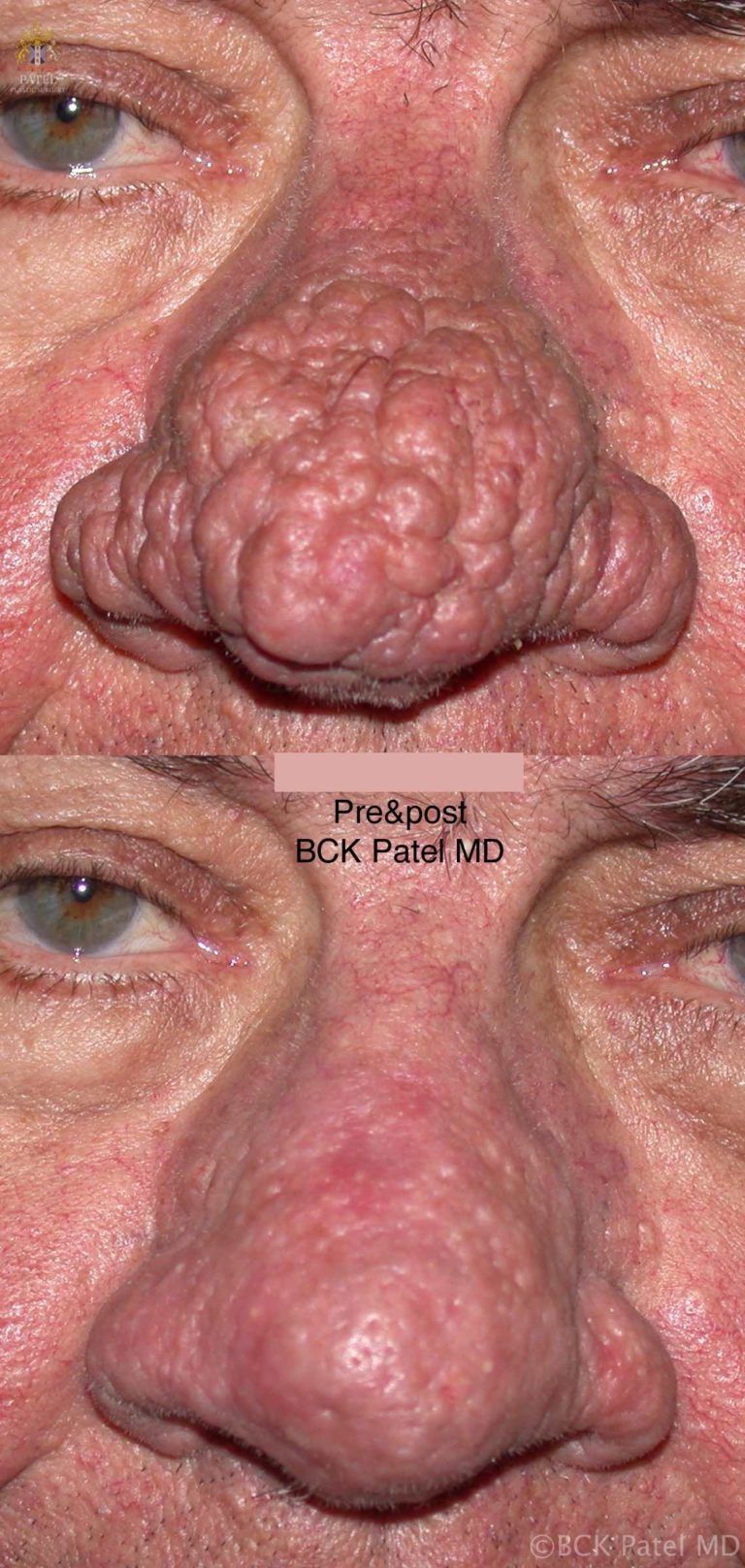 Treatment of severe rhinophyma with multiple lasers including the CO2 laser, fotofacial laser by Dr. BCK Patel of Salt Lake City