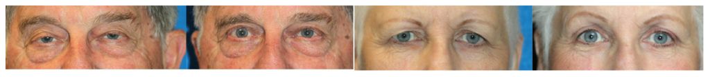 englishsurgeon.com Photos show the results of upper blepharoplasty and ptosis repair by Dr. BCK Patel MD, FRCS, Salt Lake City and St. George