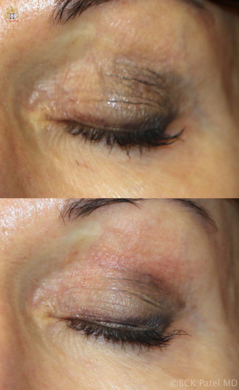 Non-surgical improvement of eyelid skin wrinkles with proper laser