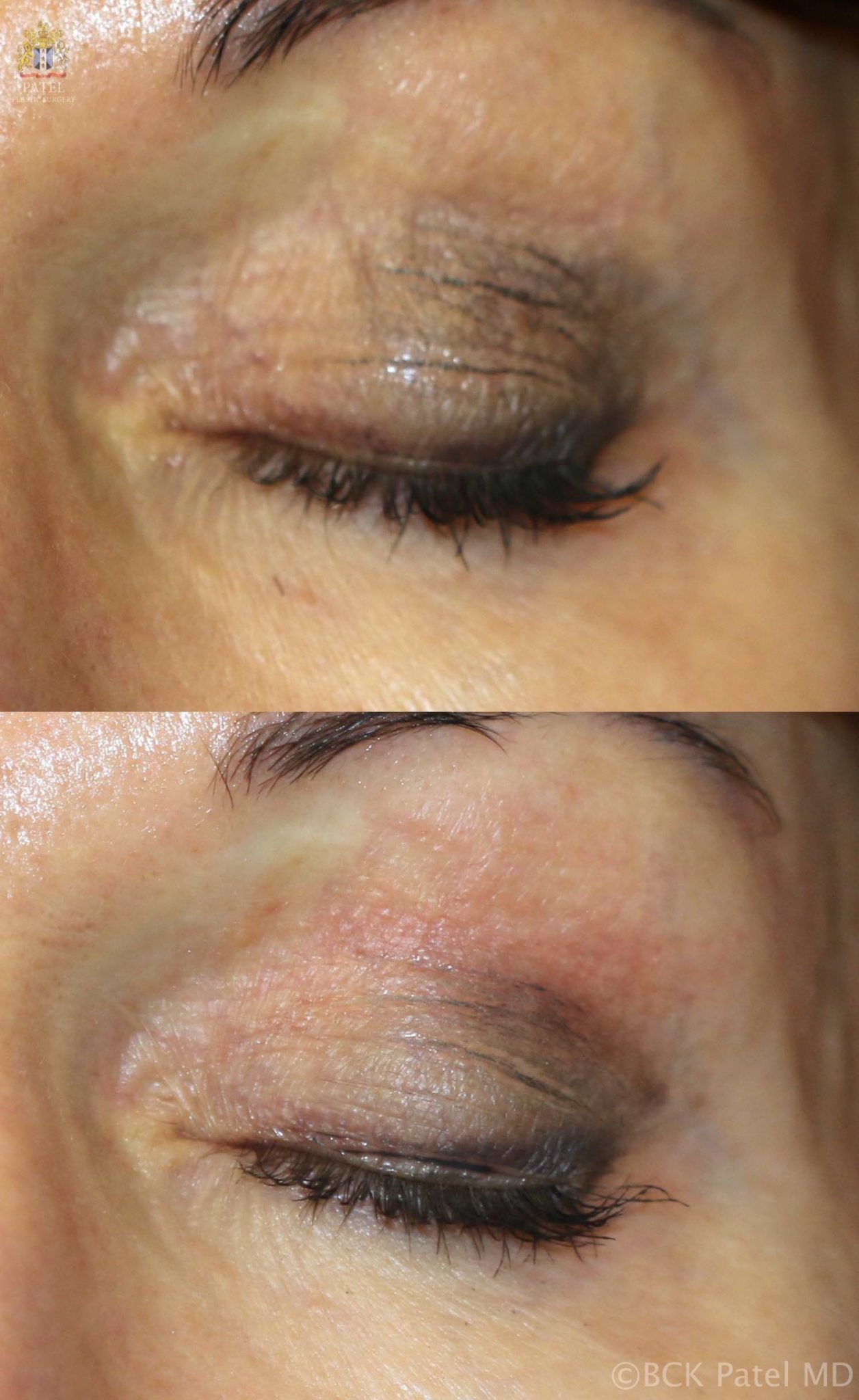 englishsurgeon.com. Photos show a nice improvement in the wrinkles and texture with CO2 laser treatment. BCK Patel MD, FRCS, Salt Lake City, St. George
