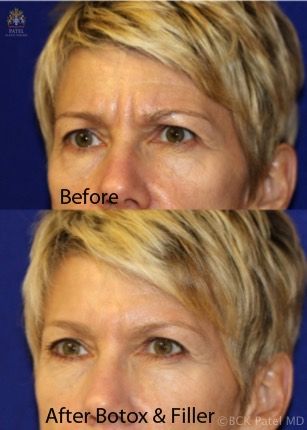 englishsurgeon.com. Photos showing the improvement in the frown lines