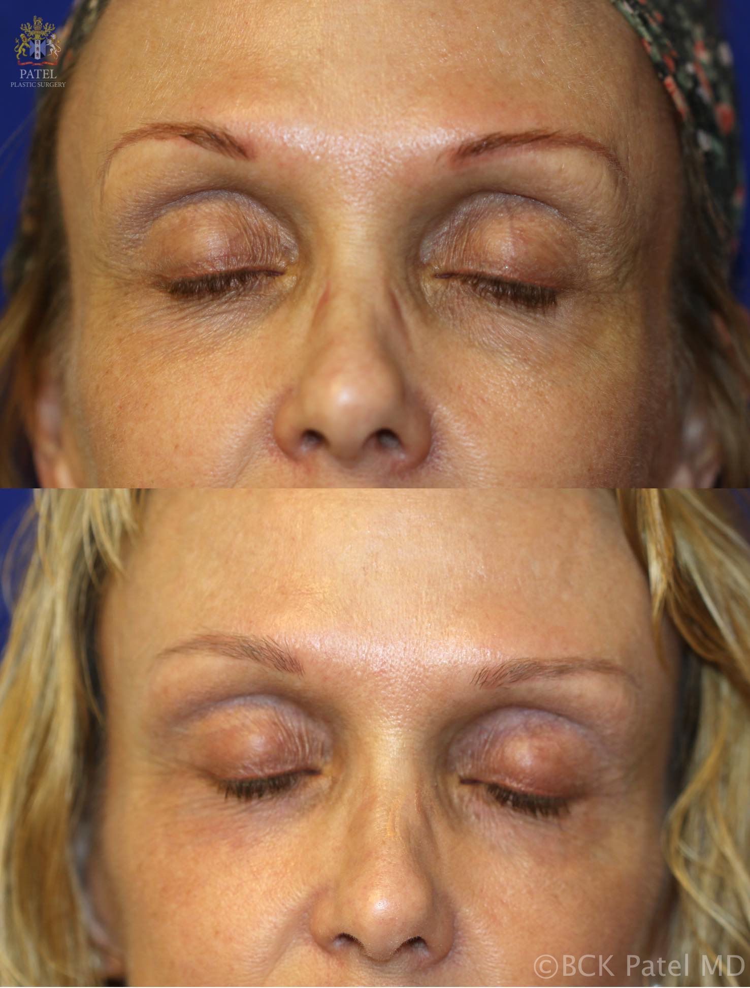 englishsurgeon.com. Photos show a nice improvement in the texture and wrinkles of the upper eyelids after use of the fractionated CO2 laser. BCK Patel MD, FRCS, Salt Lake City, St. George