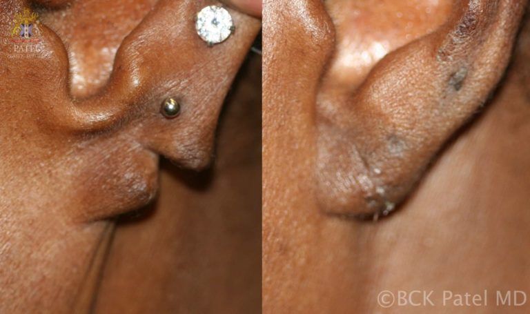 englishsurgeon.com Split earlobe repair by Dr. BCK Patel MD, FRCS, Salt Lake City, St. George
