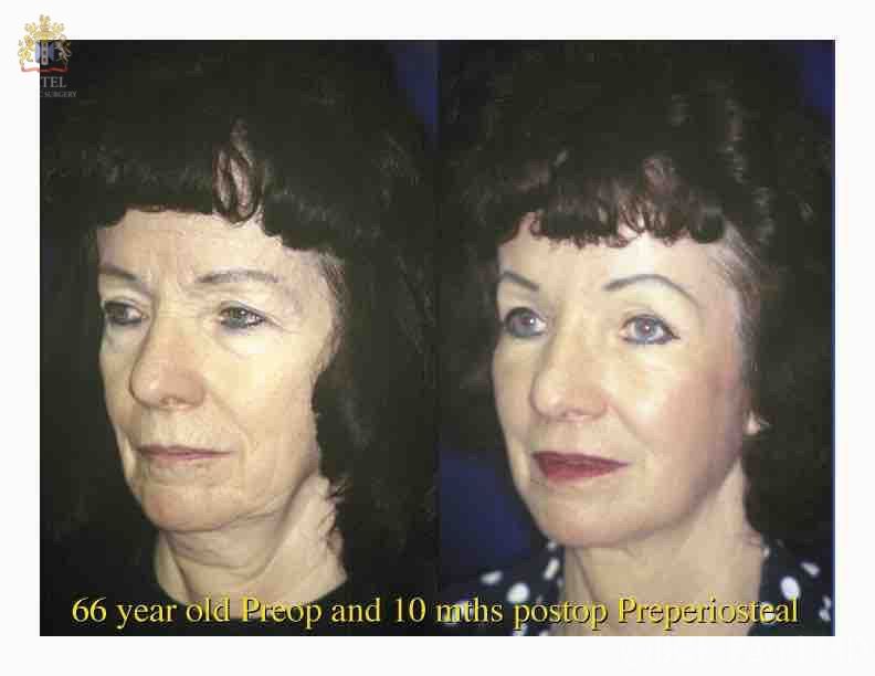 englishsurgeon.com. Photos show results of bilateral browlifts and cheek lifts