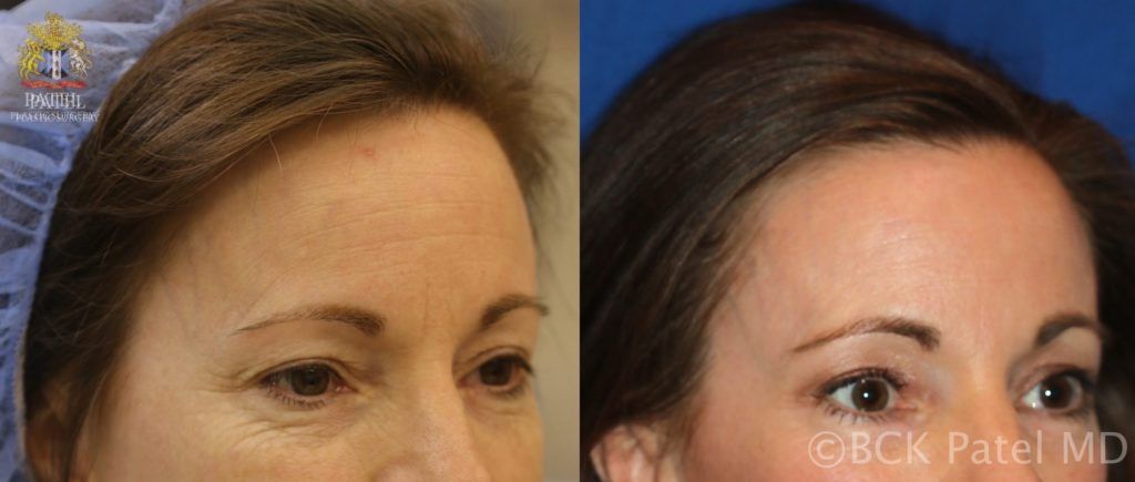 englishsurgeon.com. Improvementin the forehead skin wrinkles and coloration after fractionated CO2 laser treatment by Dr. BCK Patel MD, FRCS, Salt Lake City and St. George