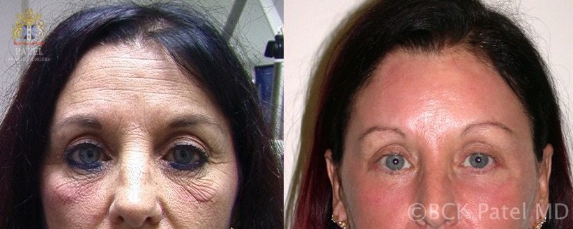 englishsurgeon.com. Improvement in forehead wrinkles and pores with the use of the fractionated CO2 laser by Dr. BCK Patel Md, FRCS, London, Salt Lake City, St. George