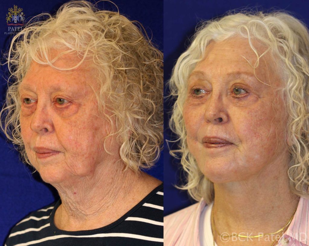 englishsurgeon.com These photos show the improvement possible with a full facelift or rhytidectomy together with fat grafts and the use of the CO2 laser and also augmentation of the chin and treatment of the lip lines and long upper lip. By BCK Patel MD, FRCS, Salt Lake City, St. George, London