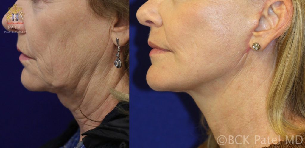 englishsurgeon.com. Photos show lower facelift and necklift with rotation of the "witch's chin" BCK Patel MD