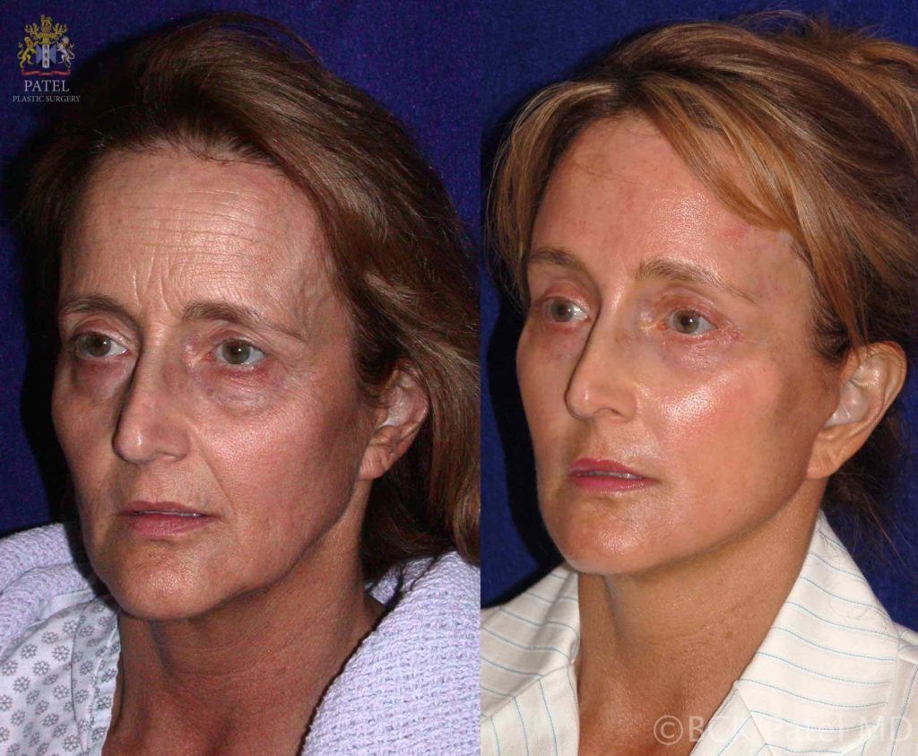 englishsurgeon.com. Beautiful improvement in the face skinin terms of wrinkles and lines after using the fractionated CO2 laser. BCK Patel MD, FRCS, London, Salt Lake City St George
