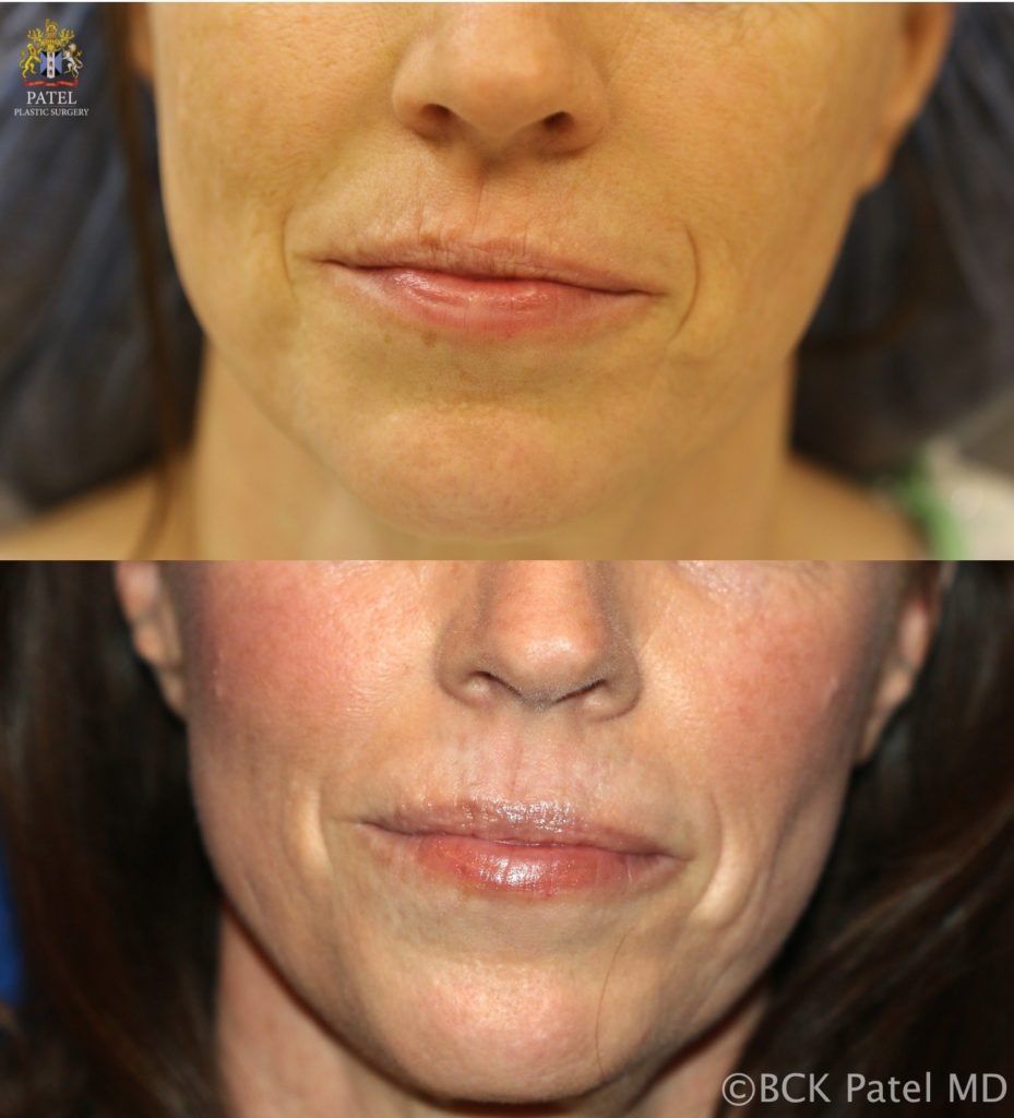 englishsurgeon.com. Nice results with improvement of lip andmouth smoker's lines with the use of the CO2 laser by Dr. BCK Patel MD, FRCS, Salt Lake City, London, St George