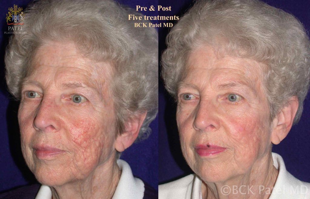Results of facial fotofacial treatments by Dr. BCK Patel MD, FRCS, Salt Lake City, St George