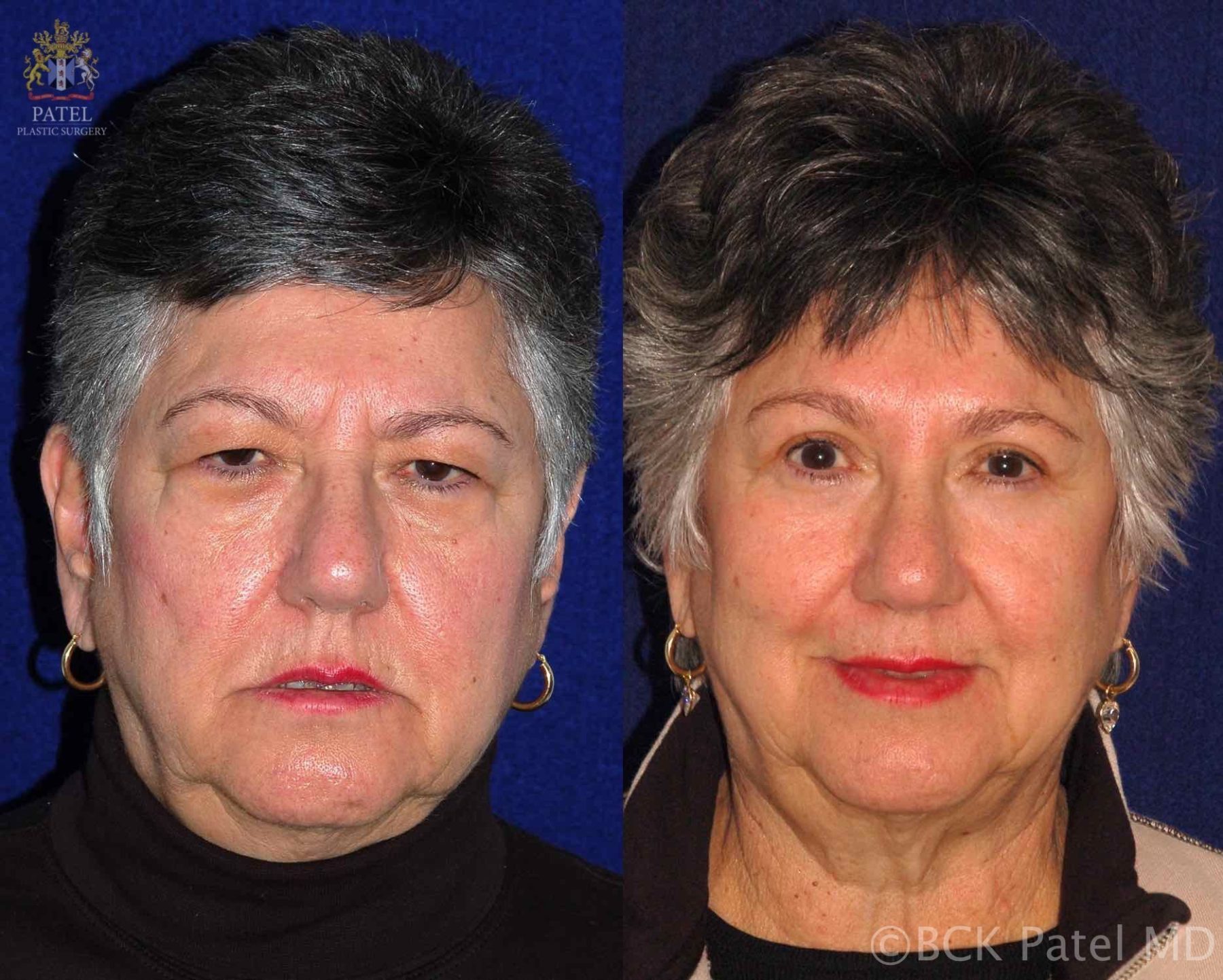 englishsurgeon.com. Photos showing results of endoscopic brow lifts