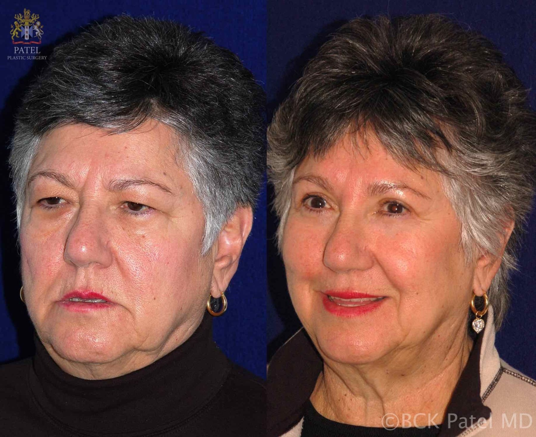 englishsurgeon.com. Photos showing results of endoscopic browlifts