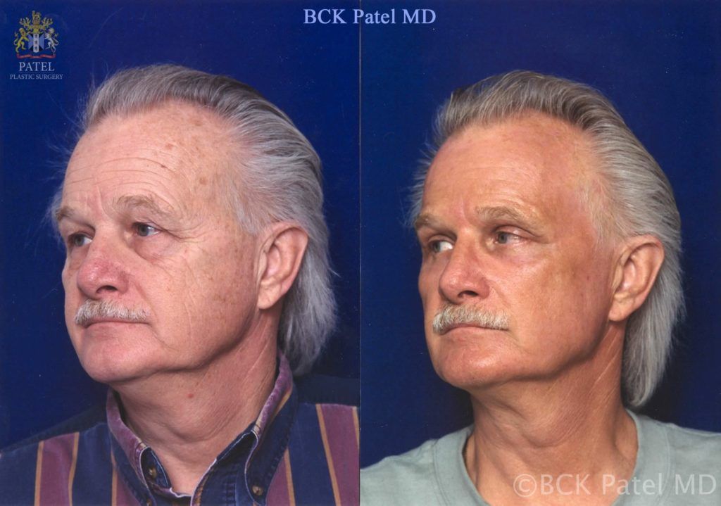 englishsurgeon.com. Results of the fractionated CO2 laser to the full face in a man by Dr. BCK patel MD, FRCS, Salt Lake City, St George, London, England