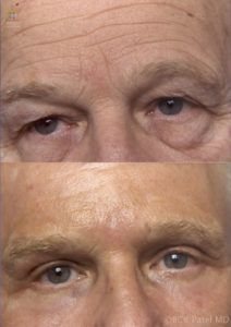 englishsurgeon.com. Photos showing the results of an upper and lower blepharoplasty and CO2 laser to the skin BCK Patel MD Salt Lake City