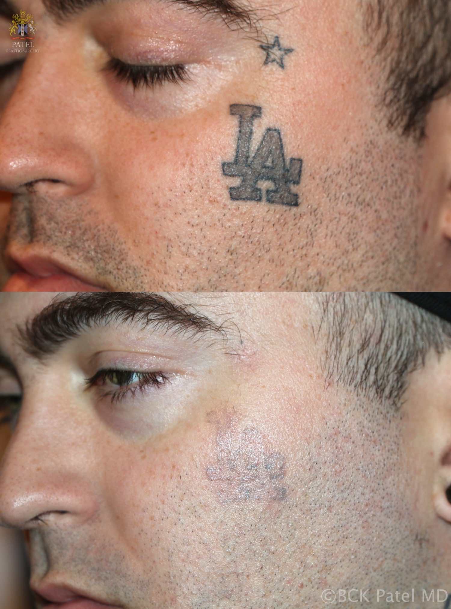 englishsurgeon.com. Photos showing removal of face dark tattoo with the laser. BCK Patel MD, FRCS, Salt Lake City, Utah, St. George