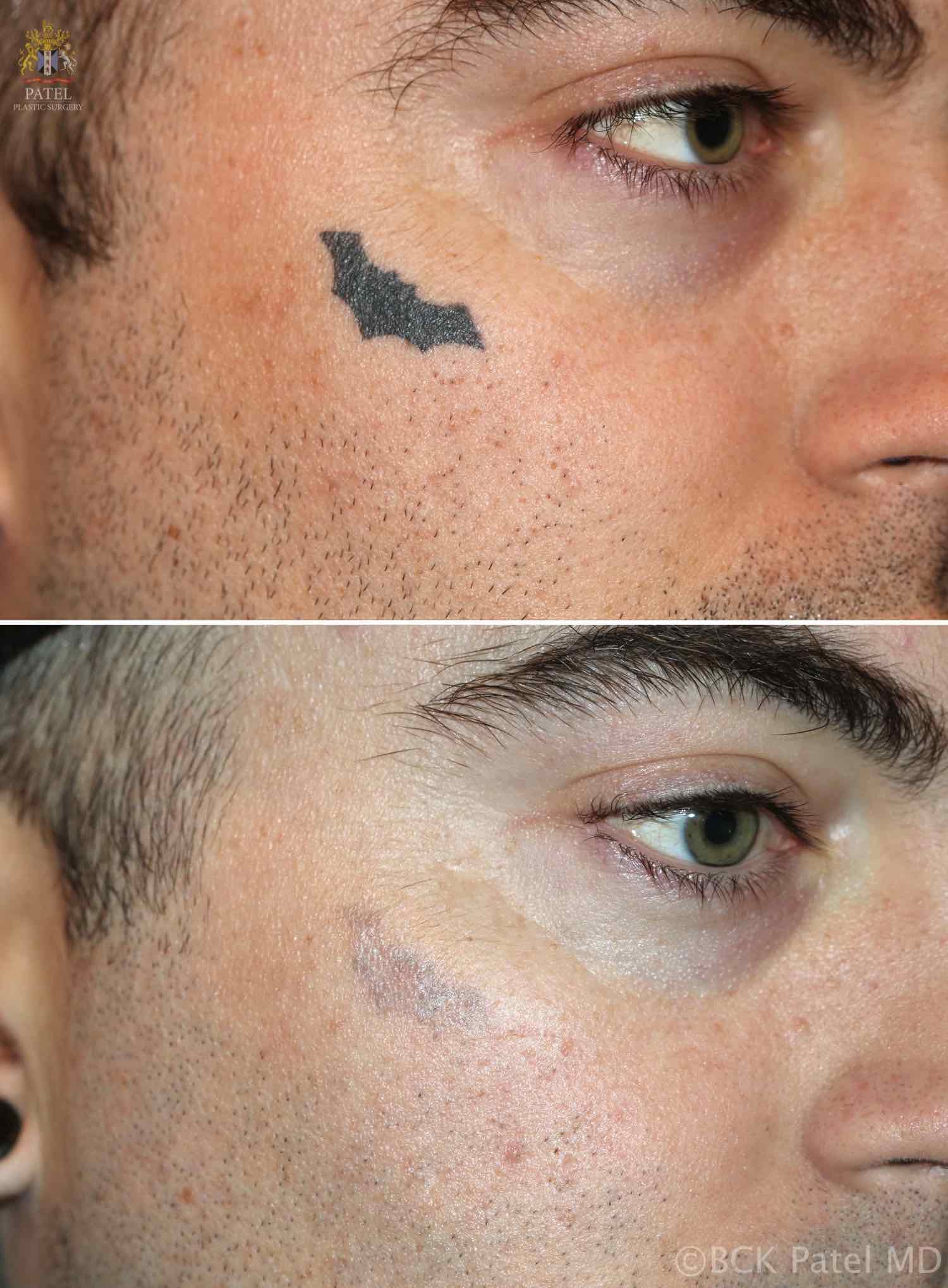 Risks of Non-Laser Tattoo Removal Methods like Acid Tattoo Removal