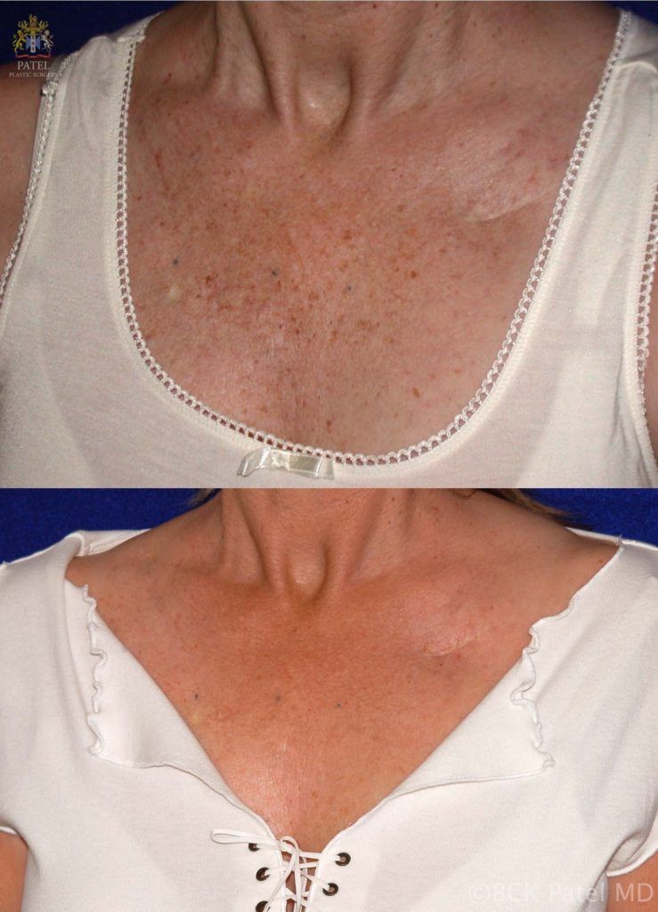 englishsurgeon.com Results of neck fotofacial treatments by Dr. BCK Patel MD, FRCS, Salt Lake City, St George