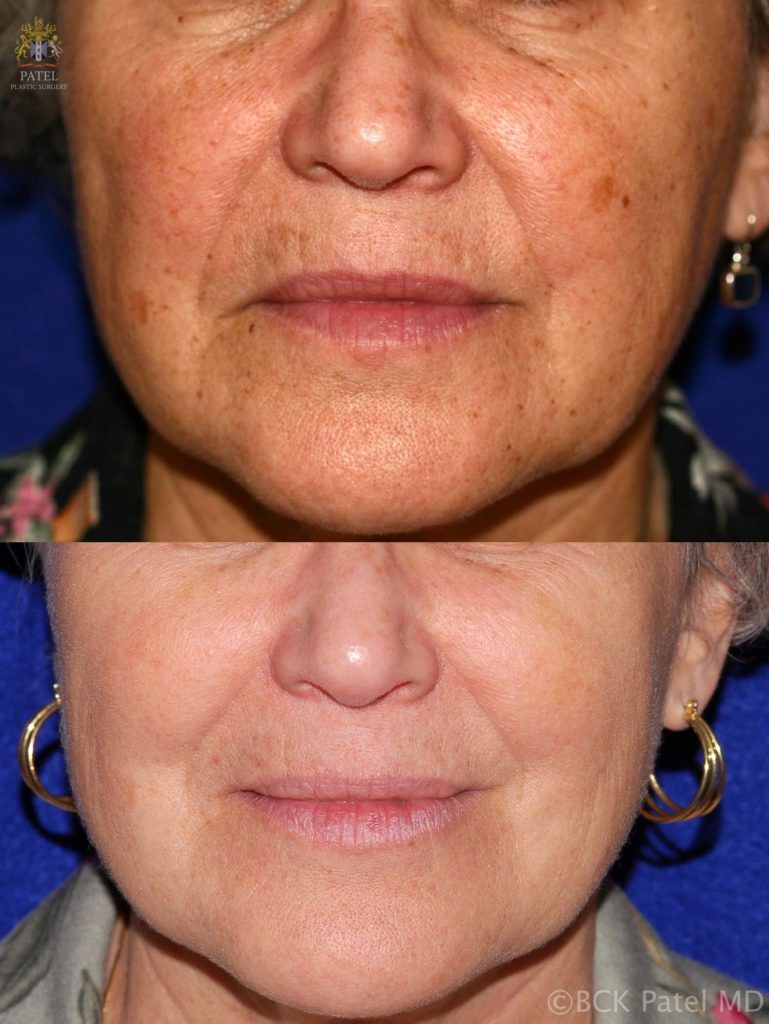 englishsurgeon.com Results of facial fotofacial treatments by Dr. BCK Patel MD, FRCS, Salt Lake City, St George
