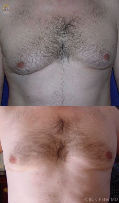englishsurgeon.com Photos showing nice improvement in gynaecomastia with vaser liposuction in a male by Dr. BCK Patel MD, FRCS of Salt Lake City and St. George