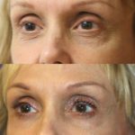 englishsurgeon.com. Photos show the improvement that can be achieved in lower eyelid wrinkles and hollows with fillers and lasers