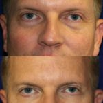 englishsurgeon.com. Photos showing improvement of the nasojugal and malar grooves of the lower eyelids with fillers