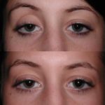 englishsurgeon.com. Photos showing correction of deep upper eyelid sulci with restylane