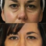 englishsurgeon.com. Photos show the improvement in the lower eyelid grooves